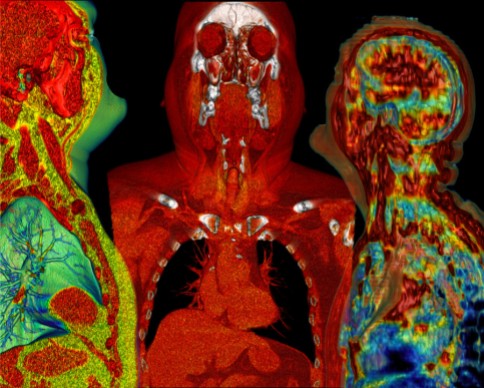 We Three Meet Again (Computed Tomography of the Head and Chest) Surface rendering of lungs, heart, and liver created in OsiriX composed and visually anonymized in GIMP