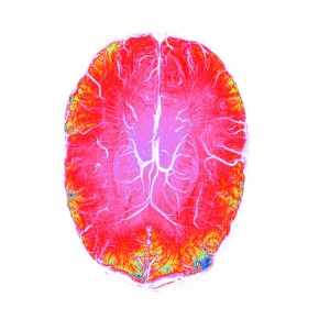 Swippy (7T Axial SWI image of the human brain) Susceptibility weighted images are particularly good at imaging blood vessels in the brain. In this image the blood vessels in the brain are bright white, surrounding by a riot of colours in the rest of the brain.